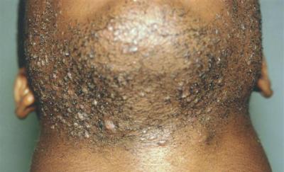 The Difference Between Razor Bumps & Ingrown Hairs.